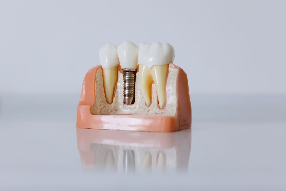 Dental implants in Korea price - Korea Medical Tourism