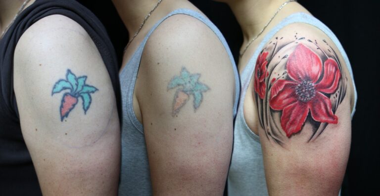 Tattoo Removal Prices in Korea: Costs by Size and Number of Sessions