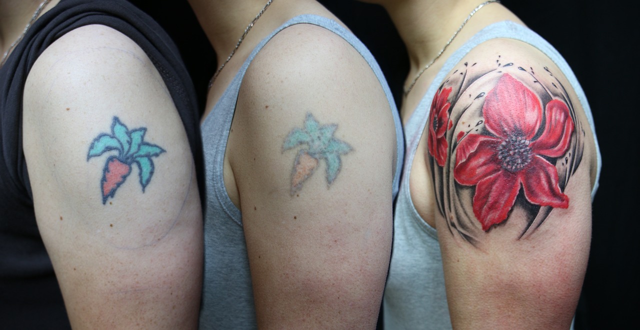 Tattoo Removal Prices in Korea: Costs by Size and Number of Sessions